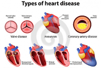 Jenis Penyakit Jantung